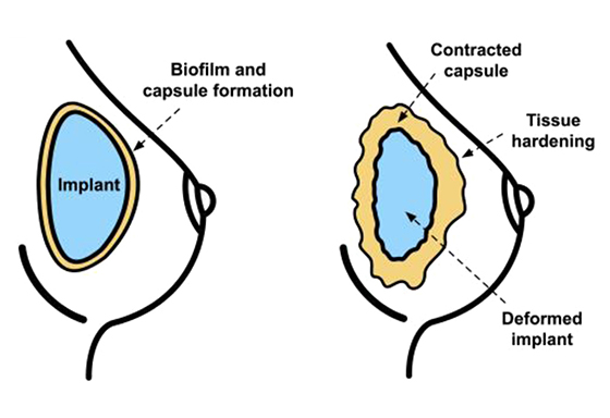Normal Capsule (LT) and Capsular Contracture(RT)