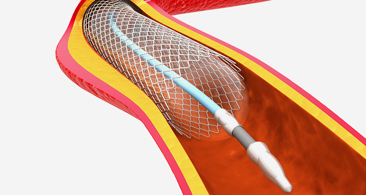 Ureteral Stent